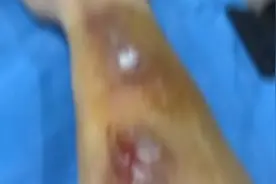 小伤口千万不能大意！男子杀鱼时指甲被划伤 右手差点废了！视频封面