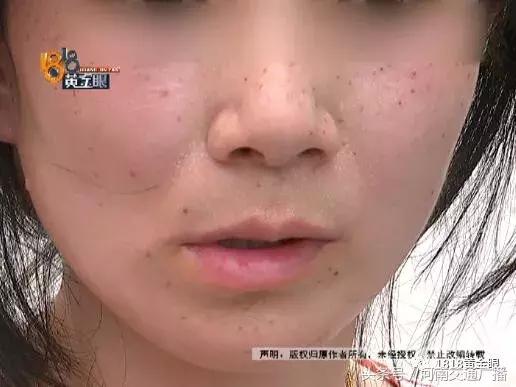 如果用激光手术去痣,那么多少钱一次（杭州女子去点痣）