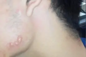 痤疮一般治疗多久能好？赶紧来看看！视频封面