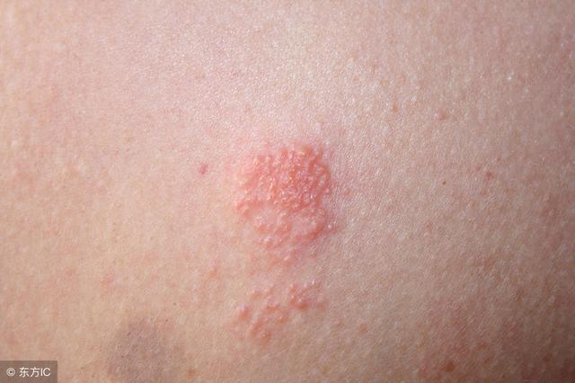 带状疱疹的临床症状与威胁讯号