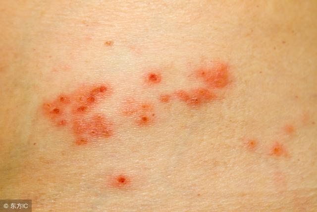 带状疱疹的临床症状与威胁讯号