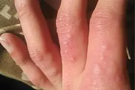 手上长水泡别着急，老中医教我1招，简单有效