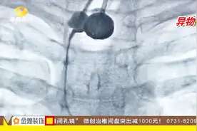 南京女子吃龙眼险些没命 原来是逗小孩时卡住气管 大家应引以为鉴视频封面