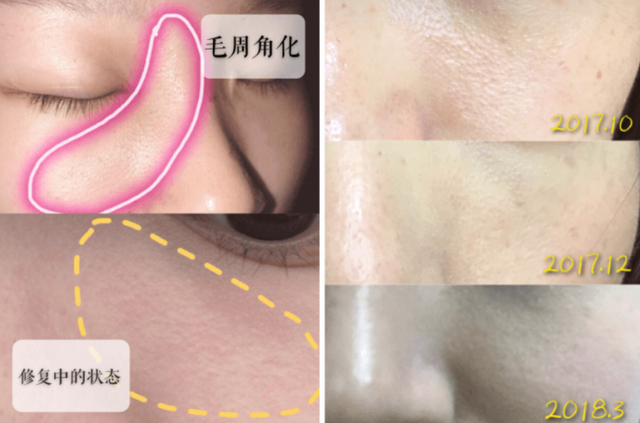 毛囊角化和脂肪粒