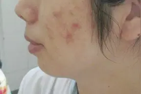 为什么会长痤疮？痤疮会不会传染？视频封面