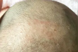 头皮长红疙瘩什么原因？原来是毛囊炎惹的祸！视频封面