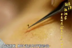 利用蜂针和蜂毒还能治疗痛风和风湿性关节炎等疾病？视频封面