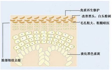 果酸治疗毛周角化症刷酸要慎重