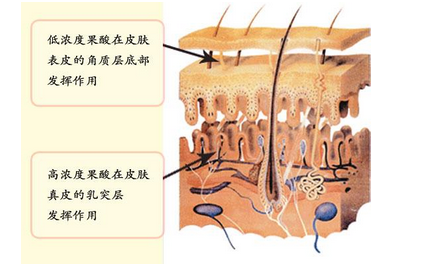 果酸治疗毛周角化症刷酸要慎重