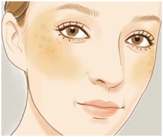 果酸治疗毛周角化症刷酸要慎重