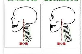 颈椎生理曲度变直，该怎么办？图片