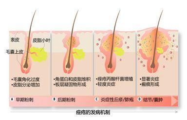 多糖酸粘多糖乳膏毛周角化