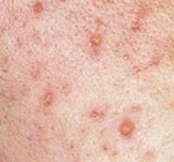 多糖酸粘多糖乳膏毛周角化