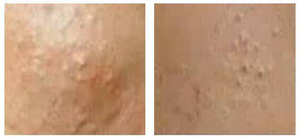 多糖酸粘多糖乳膏毛周角化