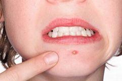 多糖酸粘多糖乳膏毛周角化