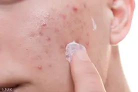 脸上长痘忍不住用手去挤？皮肤科专家：这3种痘痘千万别挤！图片