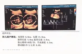 孕期胎盘老化，胎儿容易缺氧，这3类孕妈是高发人群视频封面