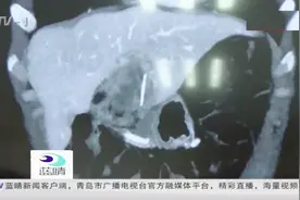 腹部疼痛难忍，手术取出拳头大的肿块，致病原因竟是一根鱼刺？视频封面