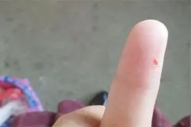 如果被狗狗牙齿刮到，到底需不需要去打针？看完要小心了视频封面