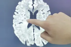 揭秘磁共振发现脑部小病灶秘密的真相，磁共振到底比CT厉害在哪里视频封面
