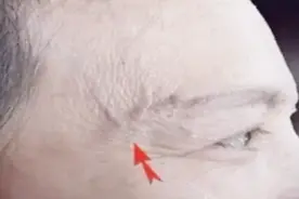 人体这些部位“青筋”暴突，可能是疾病征兆，别忽视！视频封面