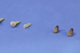 男子可乐不离手三年牙齿全烂洞 小实验：可乐泡三天 牙齿变黑变软视频封面