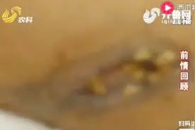 “吸脂手术”意外频发 严重可致死！让专家告诉你吸脂手术的危害视频封面