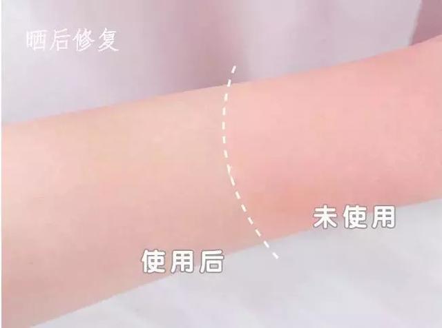 太阳晒伤可以用身体乳擦吗