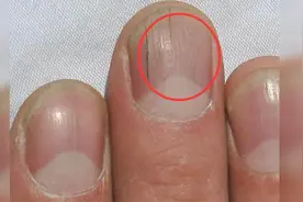 指甲突然长出这种纹路，是身体发出的什么信号？视频封面