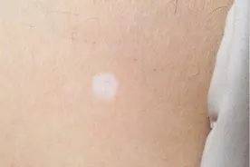 腿上有白点，是癌症的先兆吗？视频封面
