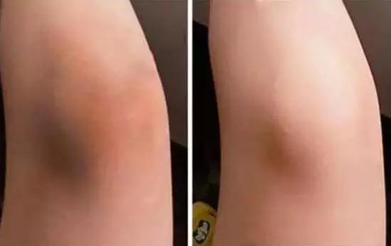 太阳晒伤可以用身体乳擦吗