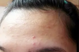 怀孕后为什么会长痘痘？据说长痘痘是怀男宝的原因，是真的吗？视频封面