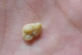 从嘴里吐出来的小石头，到底是什么东西？