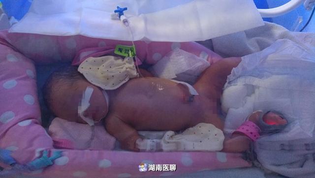 体重仅1千克！早产儿多病急需救治，“绣花姑娘”搭建生命桥梁