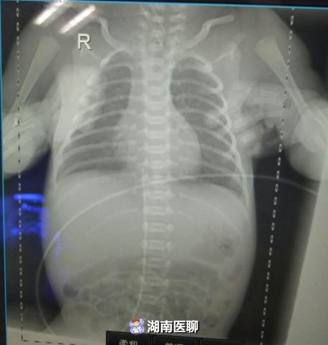 体重仅1千克！早产儿多病急需救治，“绣花姑娘”搭建生命桥梁