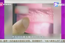琪琪看医疗：飞虫入眼怎么办？琪琪看医疗：飞虫入眼怎么办？视频封面