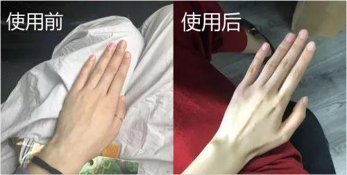 维e乳对买粥角化有作用吗