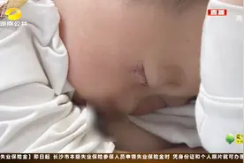 石灰蒙脸千万别用水擦拭！女童因错误处理 脸部被灼伤眼睛险失明视频封面