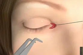 3D演示：开眼角手术，心疼各女主播1分钟视频封面