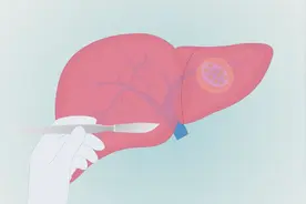 肝脓肿是怎么回事？治疗手段有哪些？多长时间治好？视频封面