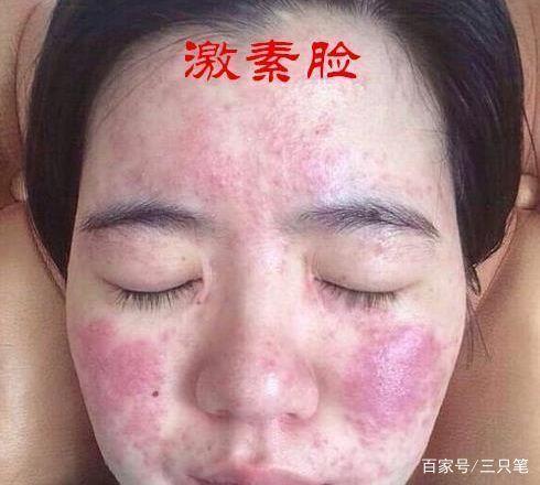 什么是激素脸？激素脸症状？如何治疗？