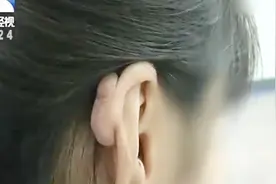女子多年前打耳洞惹出麻烦，长出“蚕豆疙瘩”，需手术处理视频封面