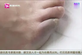 琪琪看医疗：脚趾变颜色，原因是吸烟视频封面