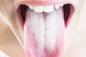 舌头上这层白色的东西到底是什么？看完千万要当心了！视频封面