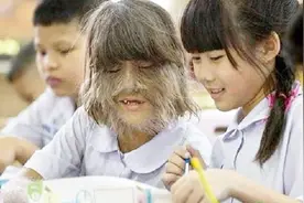 12岁女孩患罕见怪病，全身长满毛发受尽了冷嘲热讽，仍乐观面对！视频封面