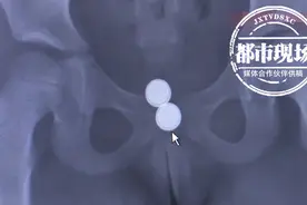揪心！5岁女童将电池塞进体内，取出时都生锈腐蚀了图片