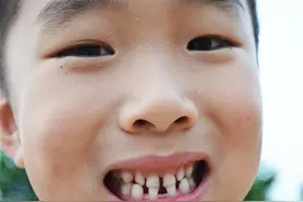 孩子满嘴“小黑牙”，是糖果吃多了吗？还是其他原因？图片