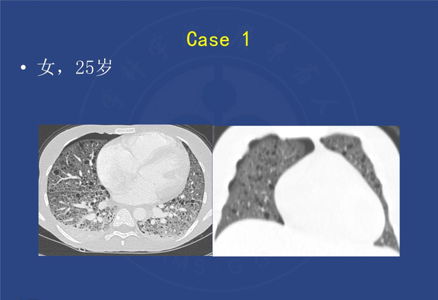 沃纳综合症，生化检查需分析患者血脂，以及尿肌酐，氨基酸的情况