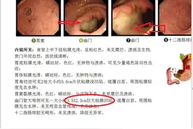 相同的上腹部隐痛，截然不同的结果图片