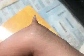 无意发现自己中指多出一块肉，你们看这是得绝症了？我还有救吗？图片